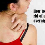 How to get rid of a rash overnight