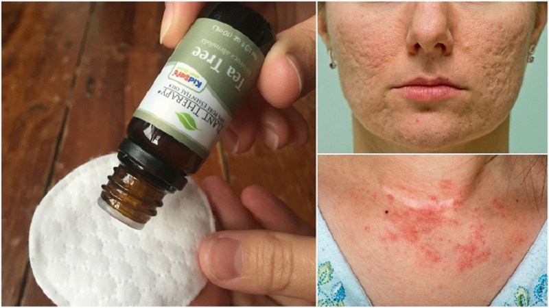 How to get rid of a rash overnight